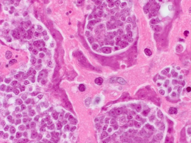 Health News: An HIV- Positive Man Died After His Parasitic Tapeworm Got Cancer