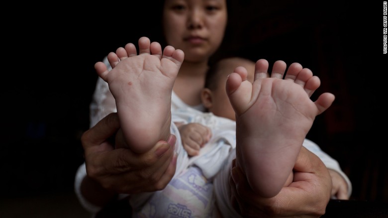 Chinese Baby Born With 31Fingers & Toes; Parents Are Praying For Surgery