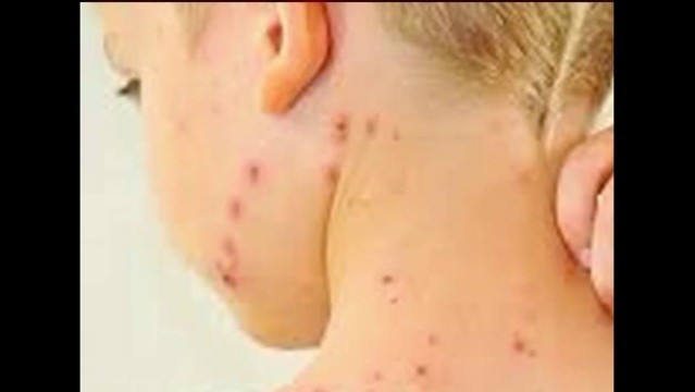 Toddler at California Daycare Diagnosed With Measles_10022498_1454513522816_1189839_ver1.0_640_360