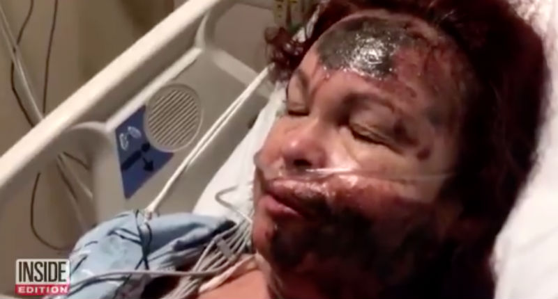 White Woman Pours Acid On Her Own Face, Destroying Her Skin & Blames A Black Woman Who Does Not Exist