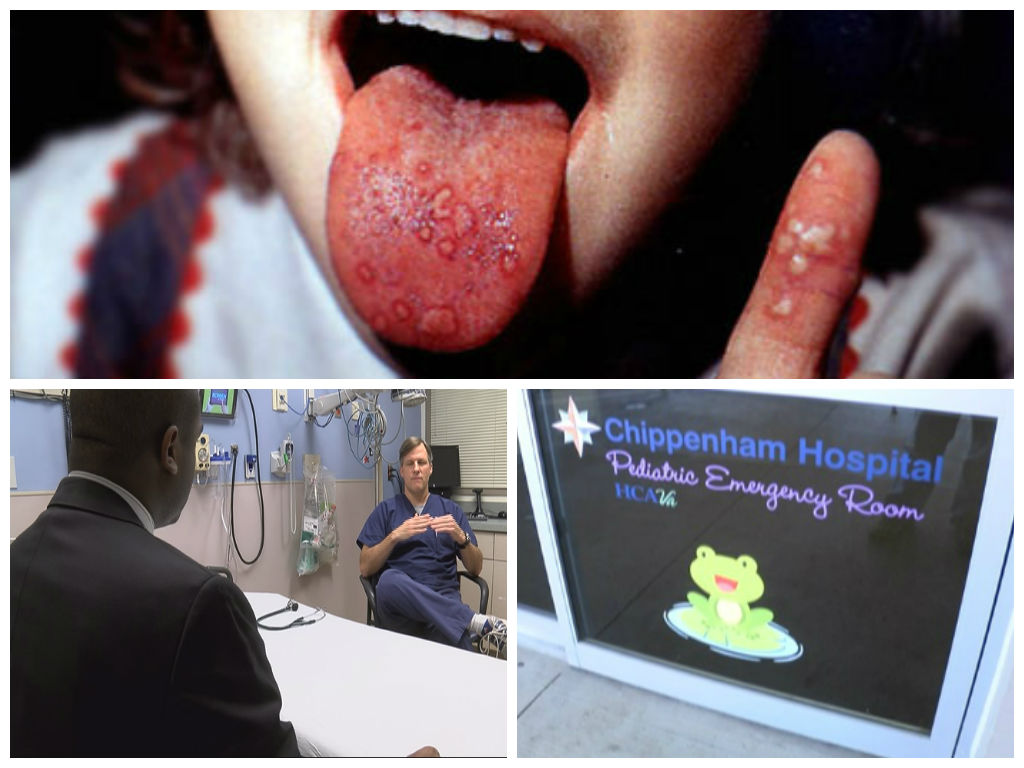 hand foot and mouth disease