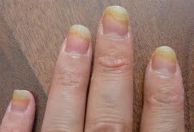 8 Health Warning Signs Your Fingernails May Be Showing You!