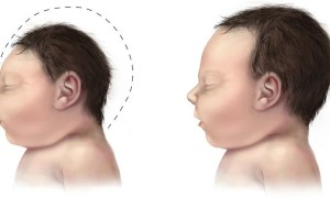 The Real Cause of Brazil’s Microcephaly Outbreak is Monsanto Partner's Larvicide Not The Zika Virus Says Doctors