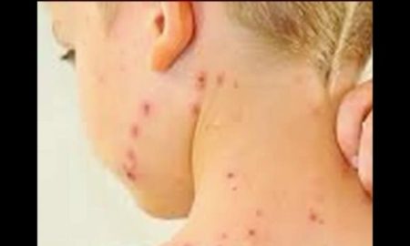 Toddler at California Daycare Diagnosed With Measles_10022498_1454513522816_1189839_ver1.0_640_360