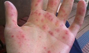 Hand Foot mouth