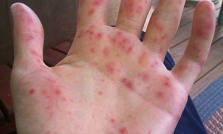 Hand Foot mouth