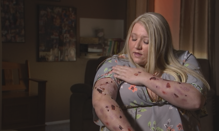 Woman Claims Her Body Is Burning Alive From The Inside Out From Painful Disease