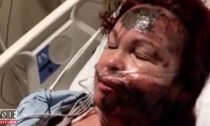 White Woman Pours Acid On Her Own Face, Destroying Her Skin & Blames A Black Woman Who Does Not Exist