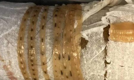 Five and A Half Foot Tapeworm Wigles Out Of Mans Body After A Diet Of Sushi
